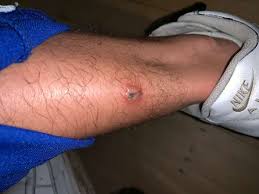 Image result for spinne biss haut reaktion