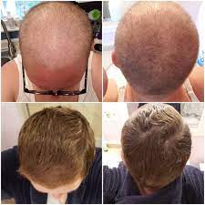 This lasts between 3 and 4 months. 3 Months Of Hair Growth After Chemo 9gag