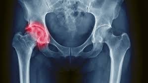 Materials used in making your artificial joints are strong and designed to last a long time inside your body. Hip Replacement Patients Present A Worrying Picture Regarding Post Surgery Exercise Investigators Say Clinical Daily News Mcknight S Long Term Care News