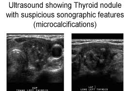 They may be hyperplastic or tumorous, but only a small percentage of thyroid tumors are malignant. The Virtual Patient Case 1 Images
