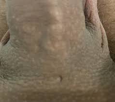 Ive done similar things before. Please Help Base Of Penis Indentation Dent Hole Penis Disorders Forums Patient