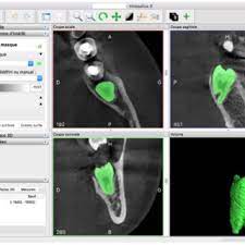Invesalius generates 3d medical imaging reconstructions based on a sequence of 2d dicom files acquired with ct or mri equipments. Selection Of The Region Of Interest Using The Invesalius Software Download Scientific Diagram