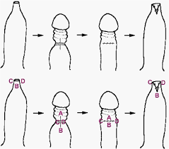 Hi guys, i've been doing some research and i think that the reason my foreskin tears during stretching is due to the scar tissue making my foreskin tighter and tighter. Phimosis Summary And Treatment Tlc Tugger Foreskin Restoration