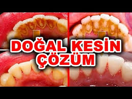 Portakal kabuğu ile diş taşı temizliği: Dis Tasi Temizleme Nasil Yapilir Kesin Cozum Saglikli Gulusler Youtube