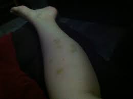 Unexplained Bruising I Have Always Bruised Lupus Uk