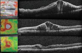 Diabetic Retinopathy And Its Treatment Prof Dr Sengul Ozdek