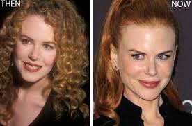 Nicole Kidman Plastic Surgery Before After Photo Before And After Celeb Surgery Com Plastic Surgery Nicole Kidman Hair Implants