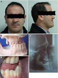 Telescopic Attachments Used in Tooth-Supported Overdentures
