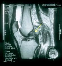 Image result for PCL Sulcus Test