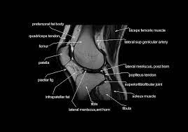 These muscles work in groups to flex, extend and stabilize the knee joint. Mri Knee Anatomy Knee Sagittal Anatomy Free Cross Sectional Anatomy Knee Mri Mri Anatomy