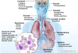 Infectious mononucleosis (im) is a clinical syndrome. Mononucleosis Picture Image On Rxlist Com