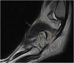 In the foot and ankle many accessory ossicles can be seen. Accessory Foot Muscle Mri Sumer S Radiology Blog
