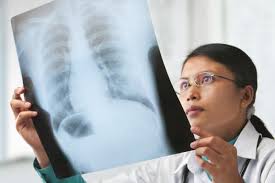 Mesothelioma Shows Promising Response To Existing Immunotherapy Drug