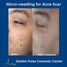 Fortunately, having an uneven face skin texture is fairly common, and there are plenty of products available to help navigate it. Microneedling Golden Pulse Cosmetic Center And Laser Clinic In Richmond Hill