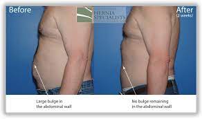 Recent Case Highlights - California Hernia Specialists