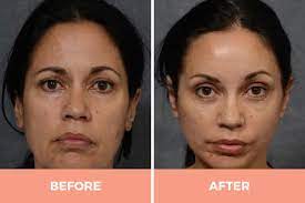 To fully understand the benefits of eyebrow and forehead lifting, one must be aware of the importance of the position of the eyebrows. Forehead Eyebrow Lift Surgery In Sydney Dr Hodgkinson