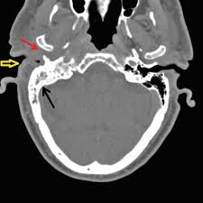 Image result for Necrotizing Otitis Externa
