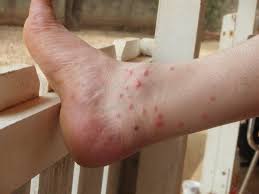 Here's what you need to know. 310 Scabies Ideas Scabies Scabies Treatment Home Remedies For Scabies