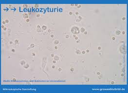 Leukozyturie Ursachen Von Leukozyten Im Urin
