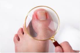 The areas most affected are the thumbnail or the big toenail. Ingrown Toenails