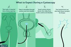Can you drink coffee before a cystoscopy. Cystoscopy Uses Side Effects Procedure Results