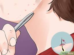 Shaving too close to the skin with a razor tends to pull and tug the skin. 4 Ways To Remove Ingrown Hair On Your Face Wikihow