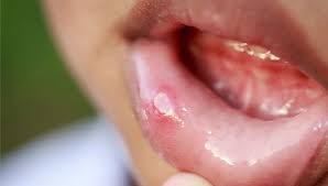 Cold sores usually appear outside the mouth, around the lips, chin, or nostrils. Patching It Up Bandages For Canker Sores