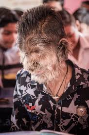 It is not to be confused with clinical lycanthropy. Indian Schoolboy 13 With Werewolf Syndrome Reveals Bullying Kids Throw Stones At Him Because He S Covered In Hair