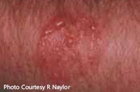 Spider bites in children are similar to bee stings in that they are easily treated, but it can depend on the spider. Bed Bug Bites Pictures Patterns Symptoms And Remedy
