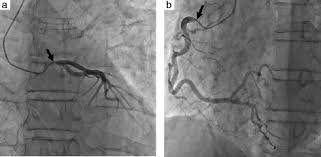 Image result for Cardiovascular Syphilis