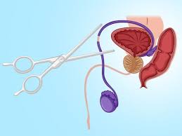 Image result for Vasectomy