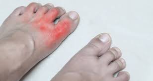 Normally, your immune system helps protect your body from infection and disease. Weight Loss Helps Symptoms Of Rheumatoid Arthritis In The Feet