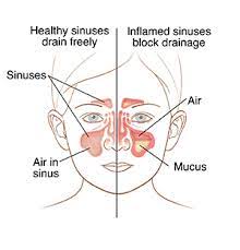 Warm compresses can ease pain in the nose and sinuses. Sinusitis In Children Cedars Sinai