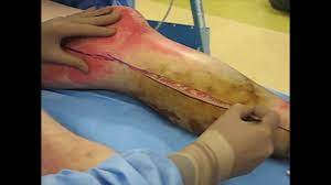 This will allow reperfusion of the limb distally or chest or abdominal expansion consider the need for escharotomy prior to transfer. Escharotomy Vic Burns