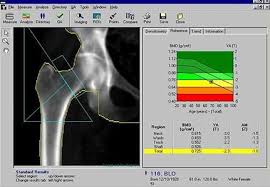 pin on bone density nutrition and exercise