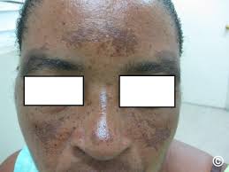 Image result for Melasma