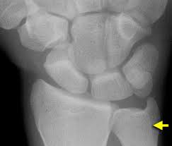 Image result for Scapholunate Dislocation