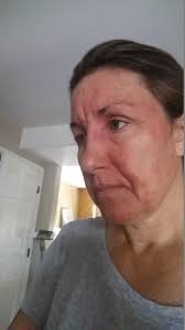 Propylene Glycol Allergy What I Did For My Red Face Propylene Glycol Allergy