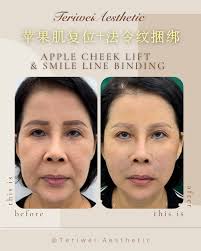 这是我妹👩🏻‍🦰 那天晚上聊着天， 讲到她最近左手收到钱右手又出去了我就告诉她， 在面相风水来讲，法令纹也叫漏财沟，  钱是赚的到，但是就比较难留住钱， 总会有一些突发事情要用到钱。 听了过后她就直接问我你手上有没有货，现在就要做。 现在做好已经2个礼拜了， 她跟 ...