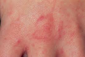 Image result for scabies symptoms