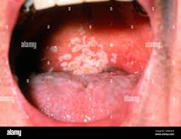 Image result for Oral thrush roof of mouth