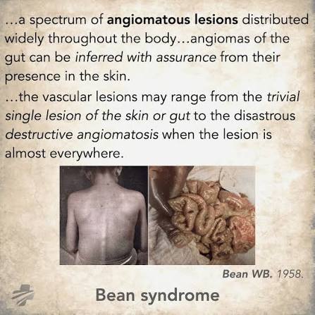 Bean syndrome or Blue rubber bleb nevus syndrome (BRBNS) is a rare vascular  disorder characterized by multiple venous malformations of varying size and  shape, involving most commonly the skin and the gastrointestinal