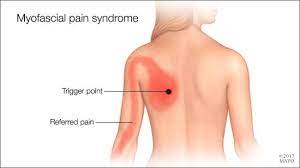 Understanding Myofascial Pain All Care
