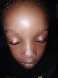 Hello, I have xanthelasma