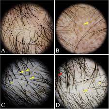A treatment with a single. Trichoscopic Findings Of Diffuse Hair Loss A Androgenetic Alopecia Download Scientific Diagram