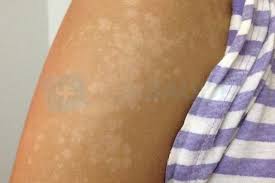 White Spots On Skin 7 Possible Causes And How To Get Rid Of Them Tua Saude