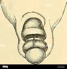 Image result for paraphimosis