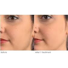 And honestly, if you don't bother remov. Michael Todd Beauty Sonicsmooth Sonic Dermaplaning Tool 2 In 1 Facial Exfoliation Peach Fuzz Hair Removal System Ulta Beauty