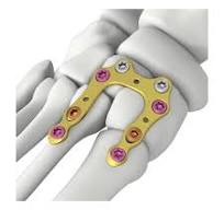 Itval U-shape Locking Plate,Medical Device Manufacturers ...