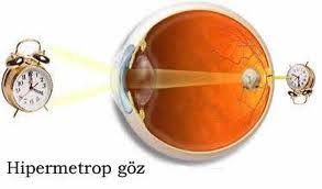 Rekraktif Tedavi Universalgoz
